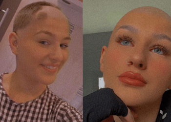 Egremont teen, 17, talks about living with alopecia