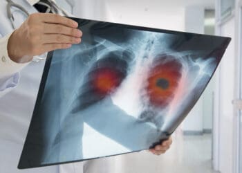 Cumbria’s cancer rate highest in North West, says new data