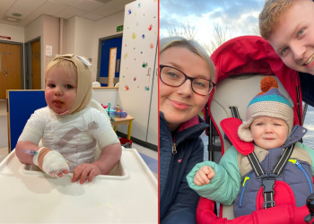 Cumbrian mum praises GNAAS after accident left toddler with horrific burns